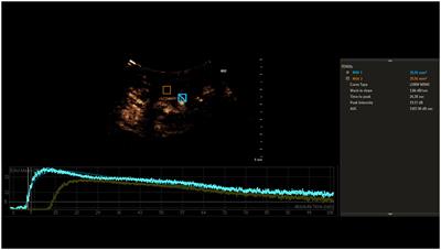 Optimizing the prediction of sepsis-associated encephalopathy with cerebral circulation time utilizing a nomogram: a pilot study in the intensive care unit